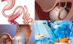 Gastrik Bypass Ameliyatı Hangi Durumlarda Önerilmez?